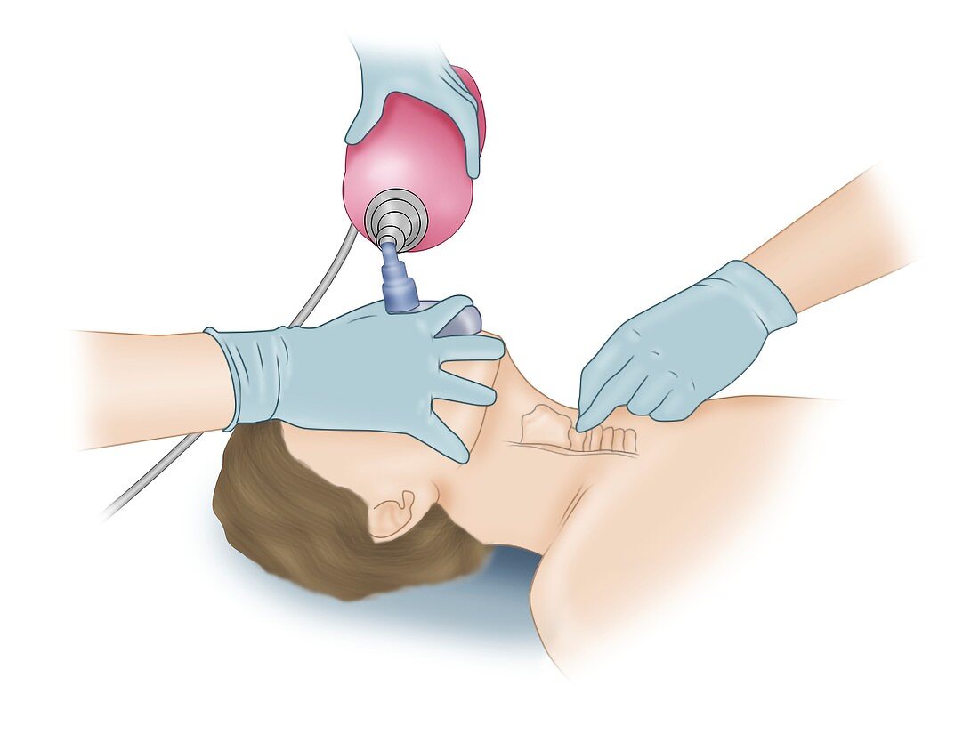 Tracheal intubation, illustration