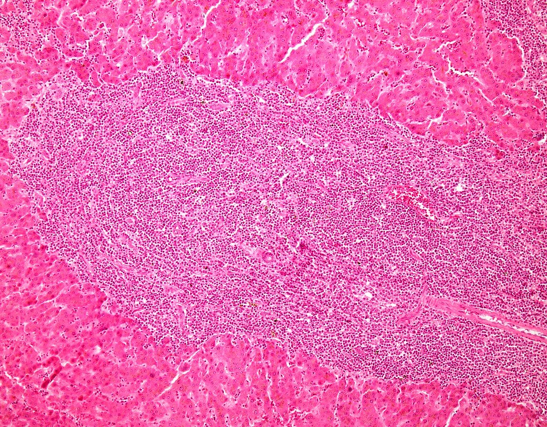 Small lymphocytic lymphoma, light micrograph