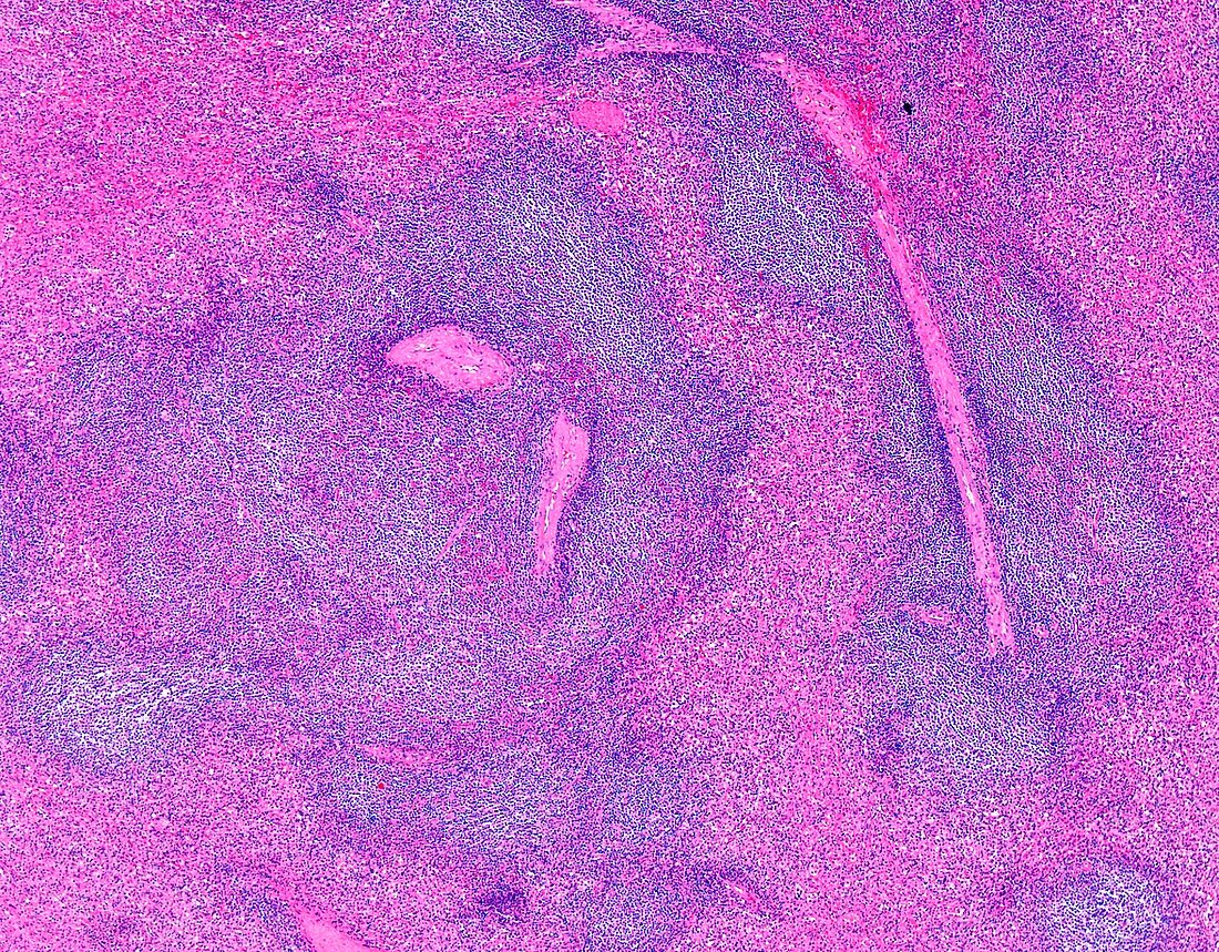Small lymphocytic lymphoma, light micrograph