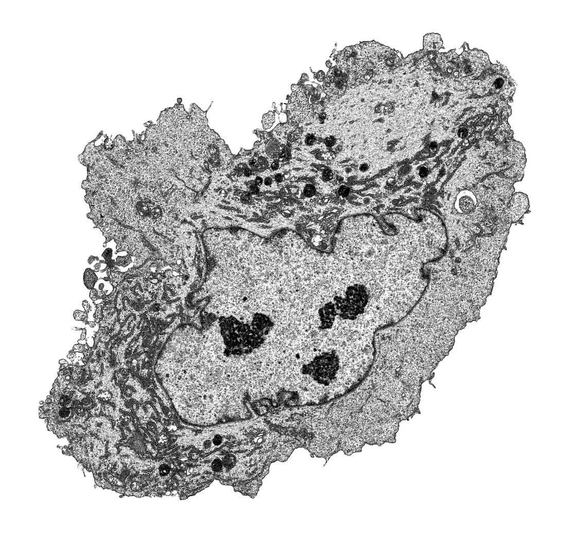 Lung cancer cell, TEM