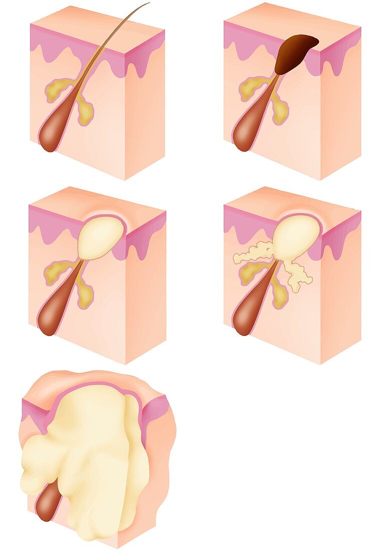 Infected hair follicle in acne, illustration