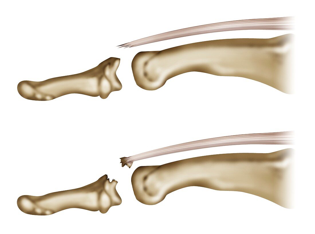 Fingertip tendon injury, illustration