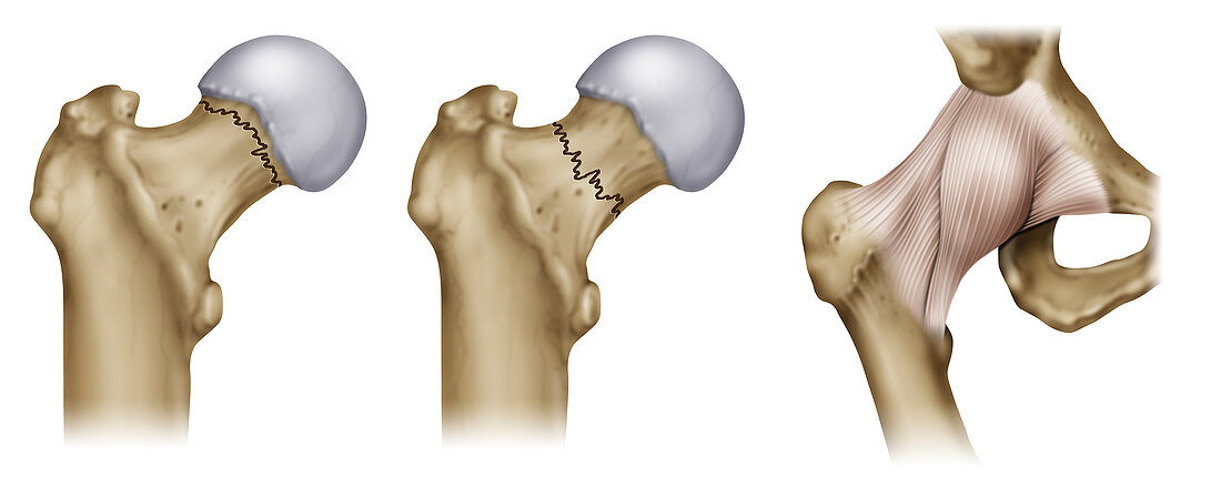 Femur neck fractures, illustration