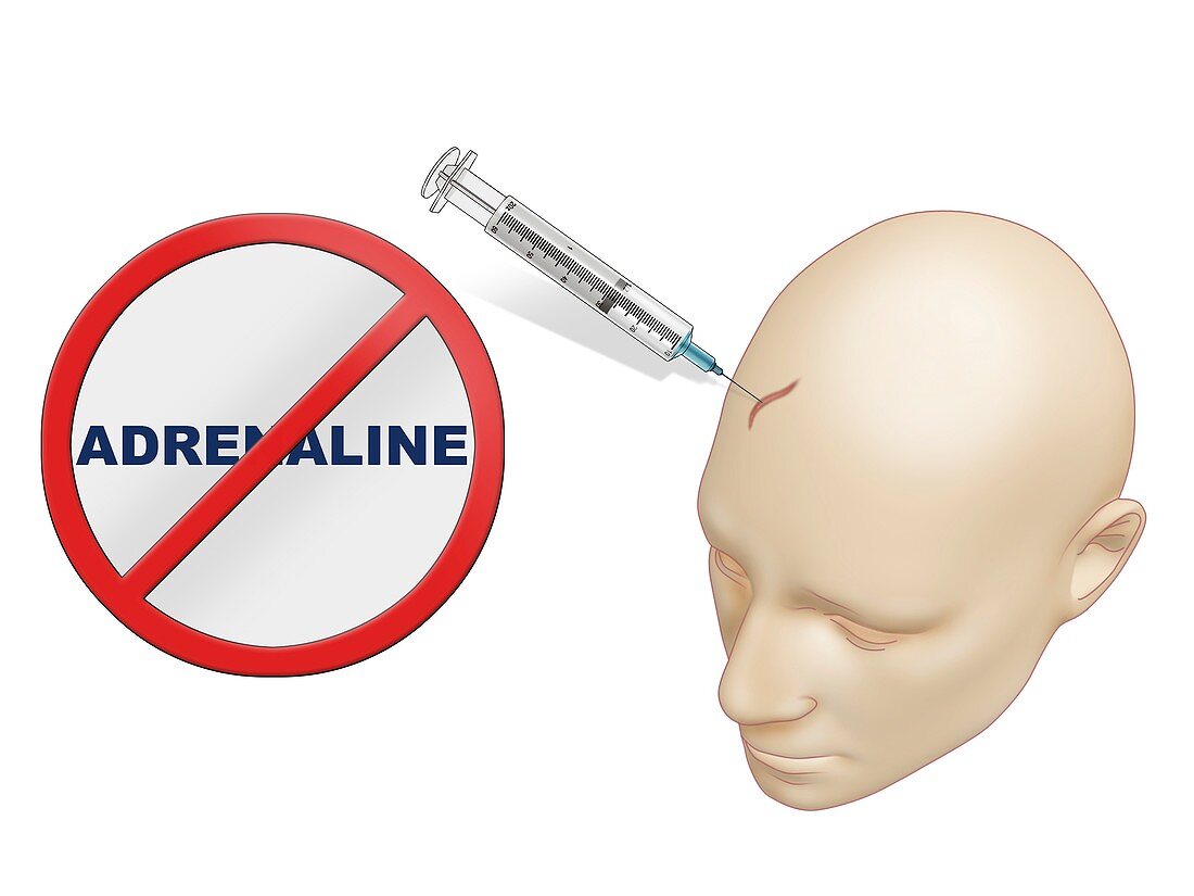 Use of adrenaline in woundcare, illustration