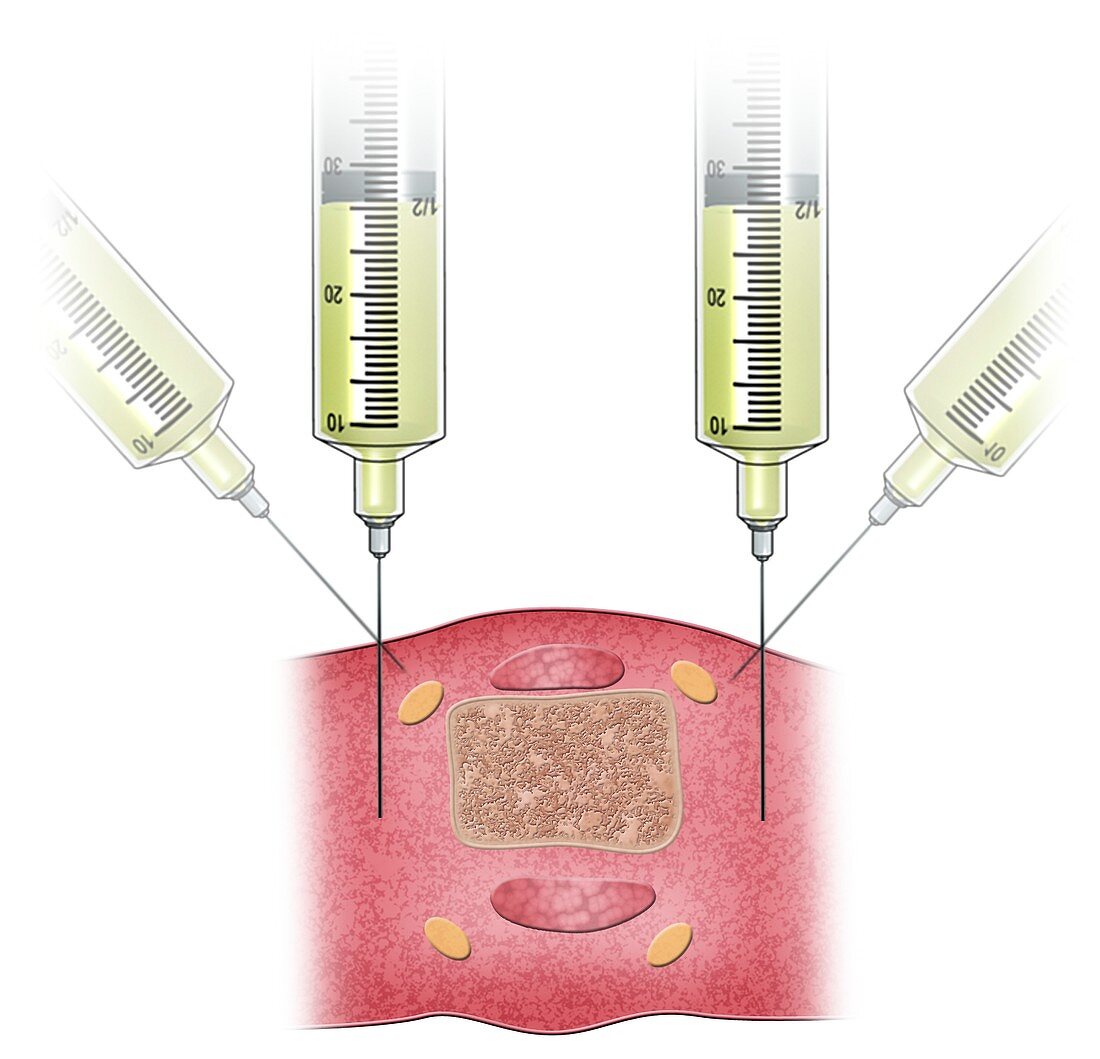 Nerve block injection, illustration