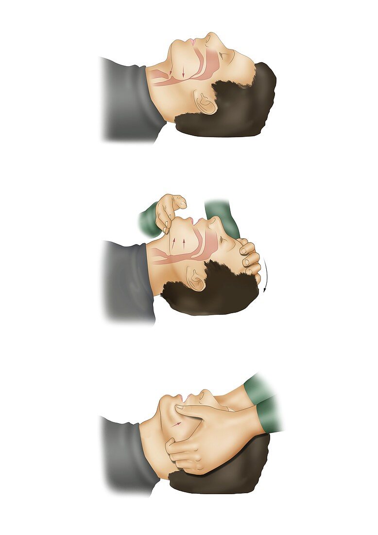 First aid head tilt technique, illustration