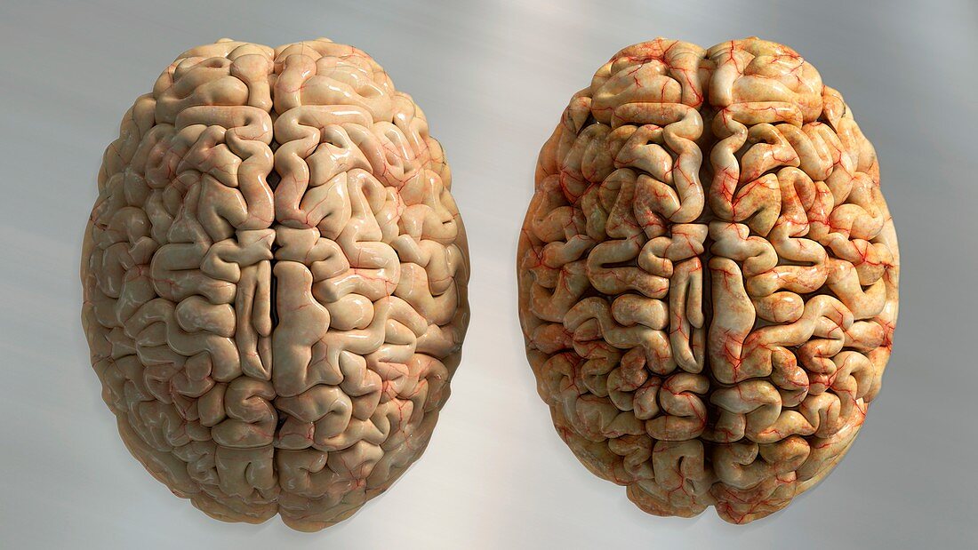Healthy brain and brain in Alzheimer's, illustration