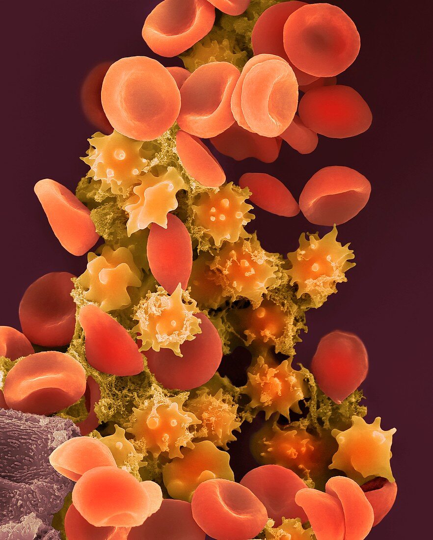 Crenate red blood cells, SEM