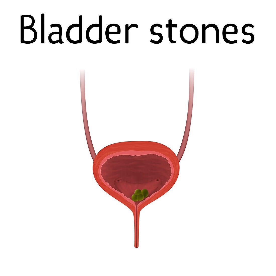 Bladder stones, illustration