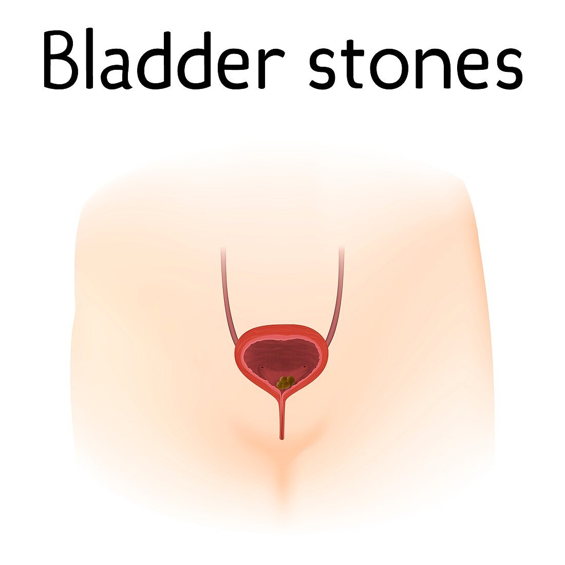 Bladder stones, illustration