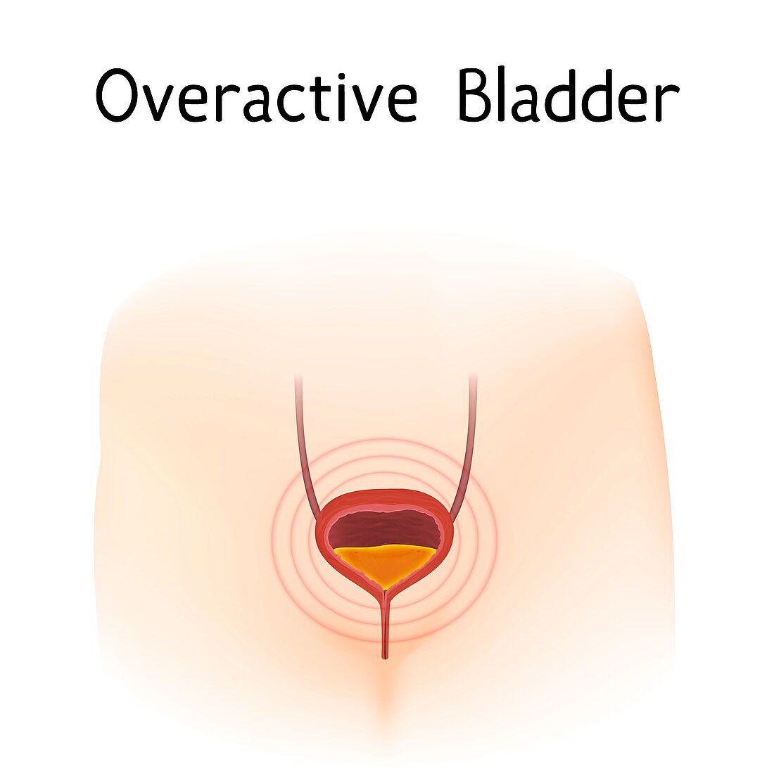 Overactive bladder, illustration