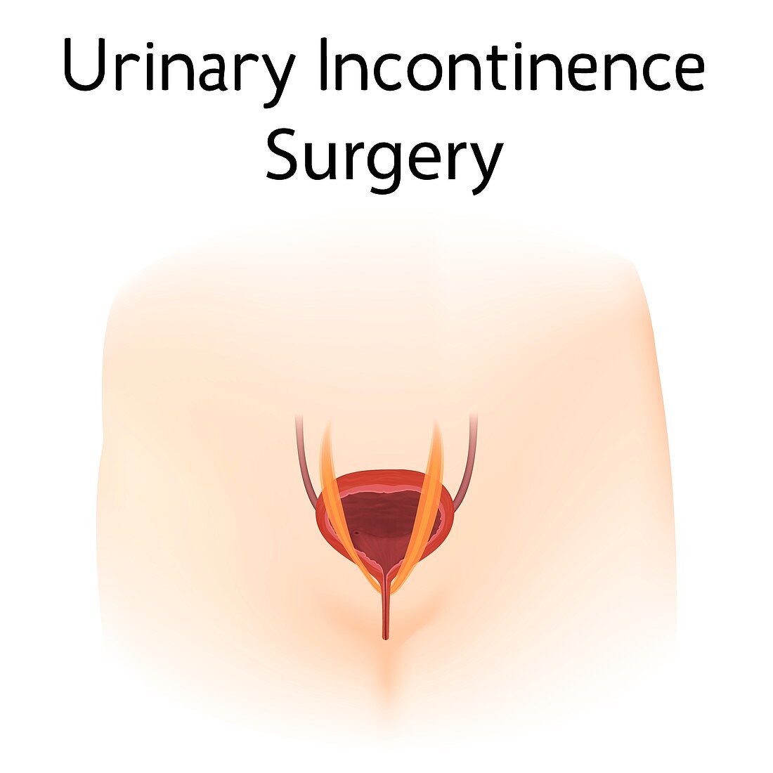 Urinary incontinence surgery, illustration