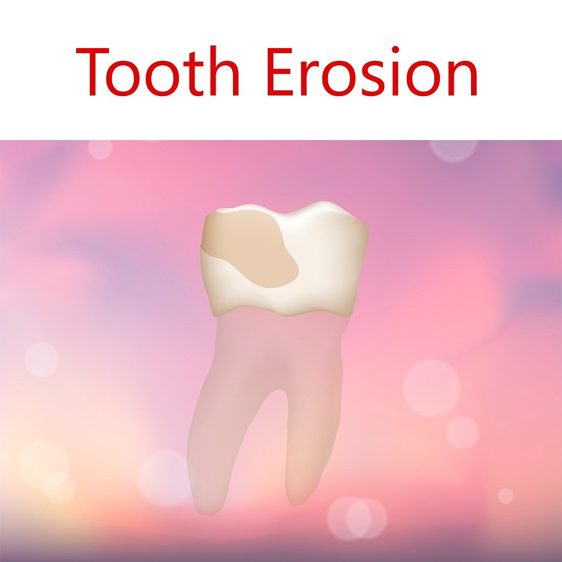 Tooth erosion, illustration