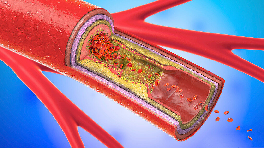 Atherosclerosis, illustration