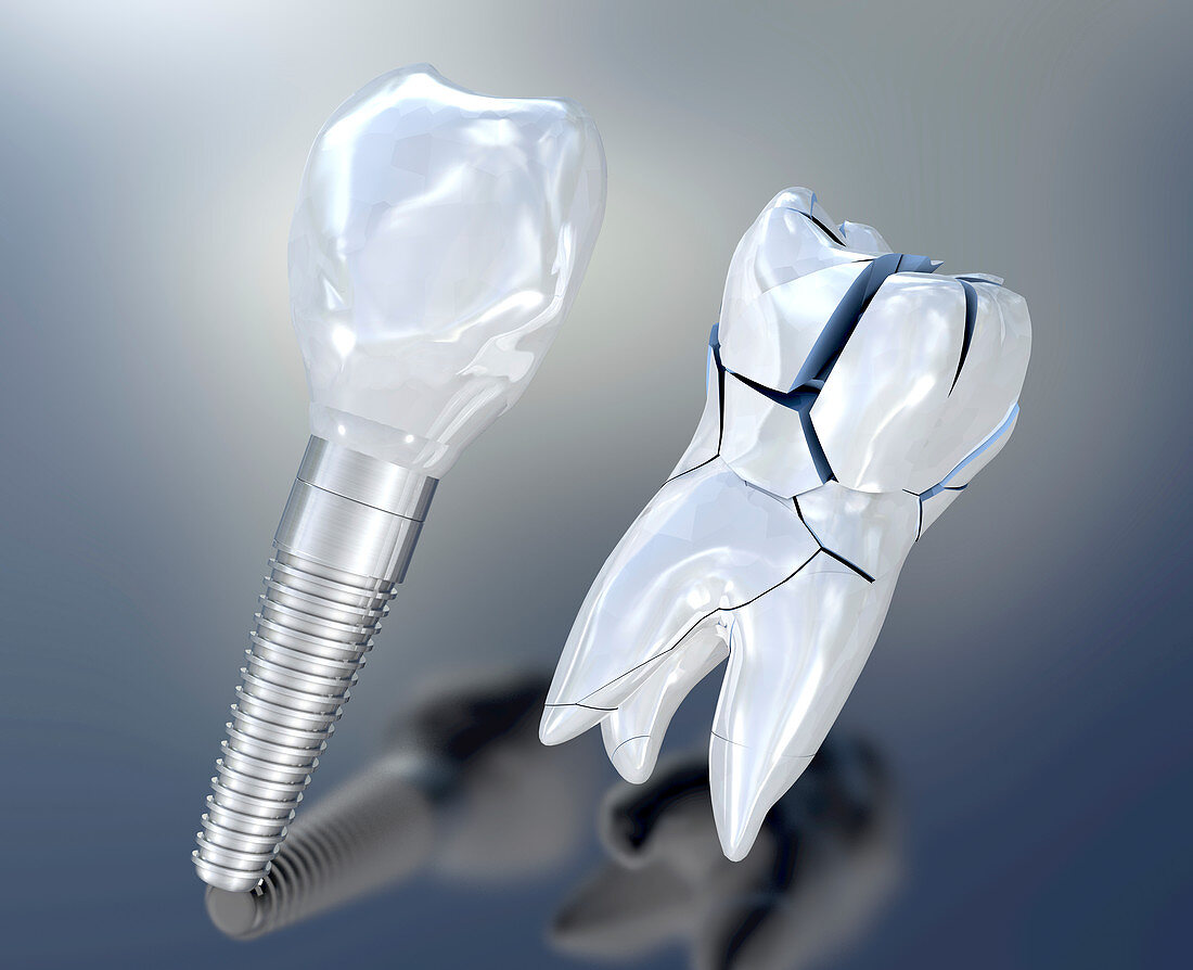 Dental implant, illustration