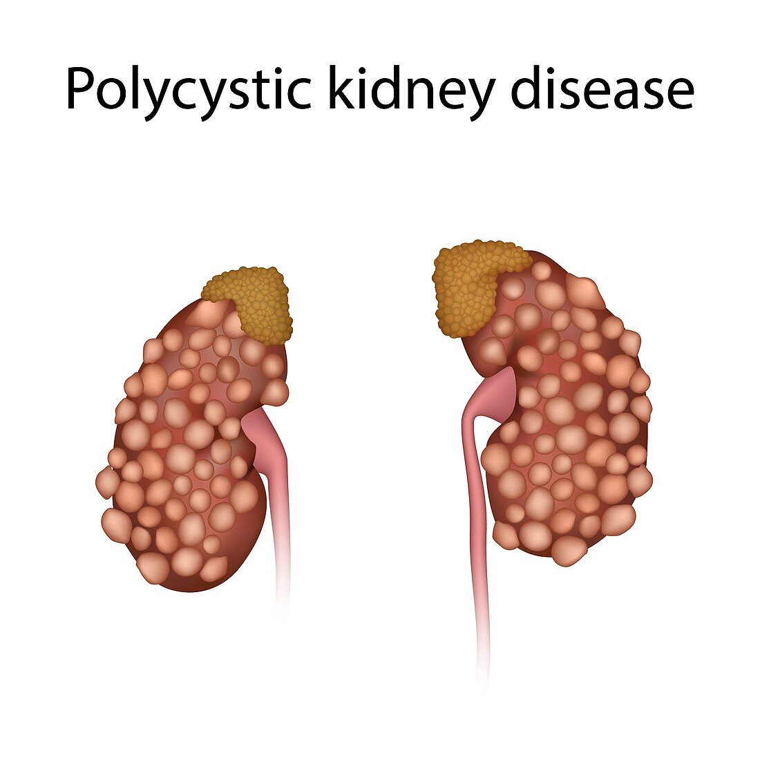 Polycystic kidney disease, illustration