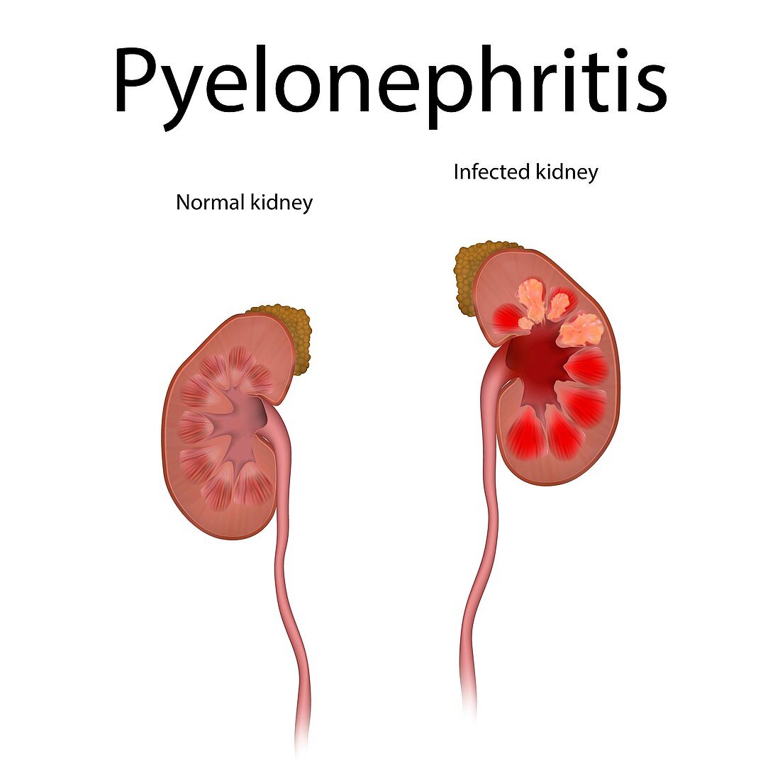 Pyelonephritis, illustration