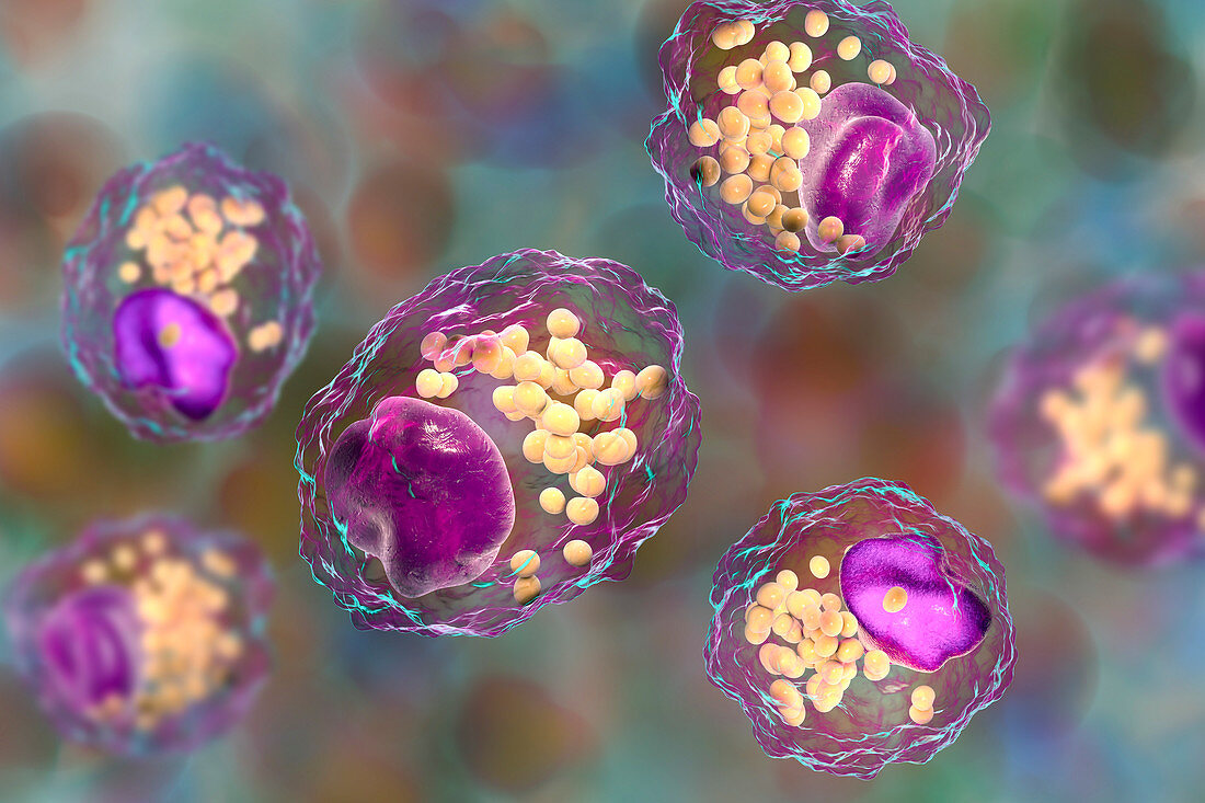 Macrophage foam cell, illustration