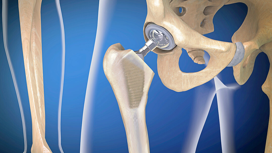 Hip replacement, illustration