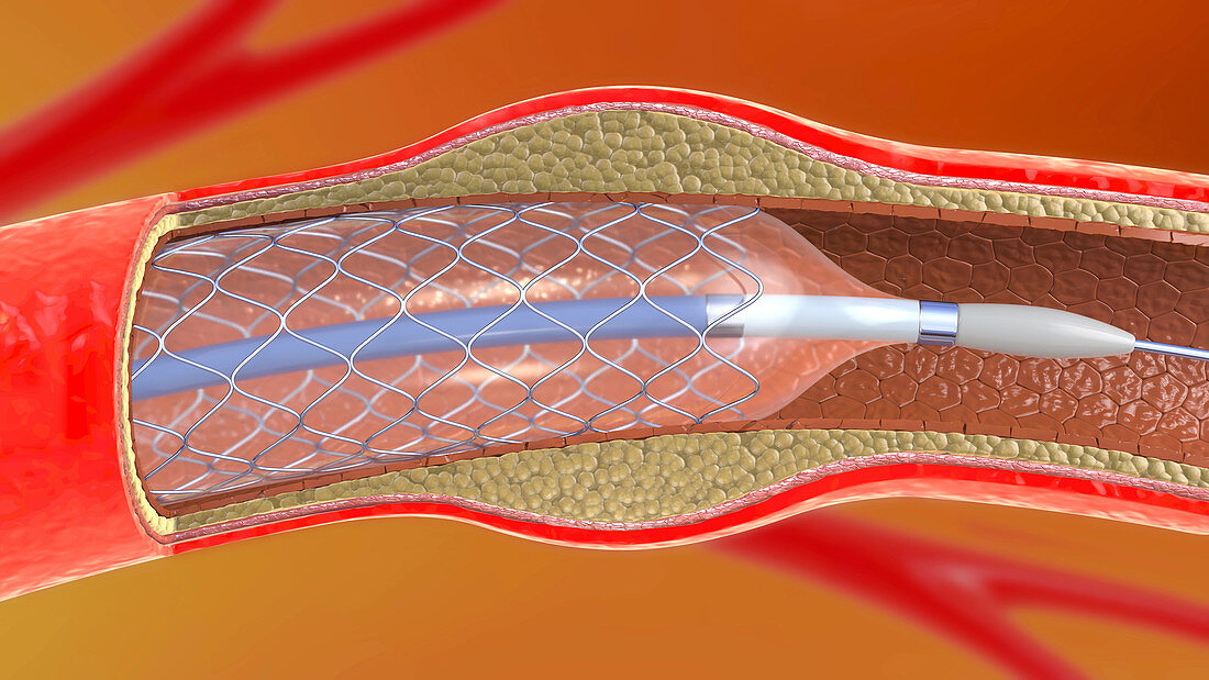 Arterial stent, illustration