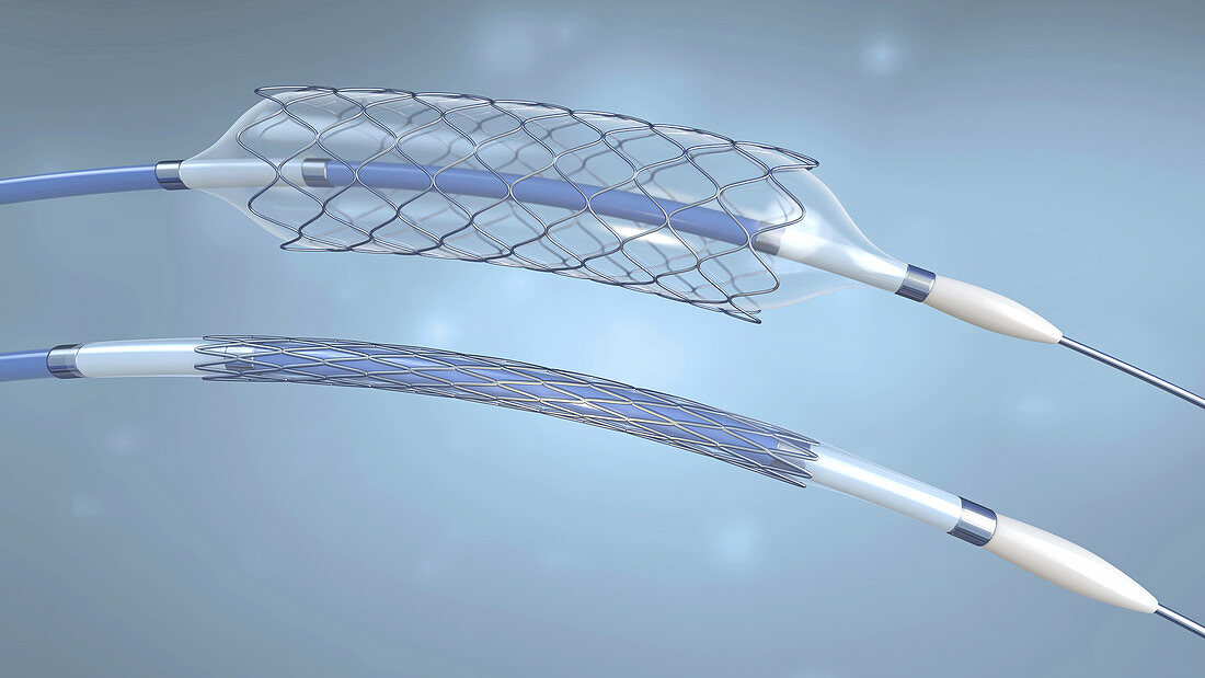 Stents and balloon catheters, illustration