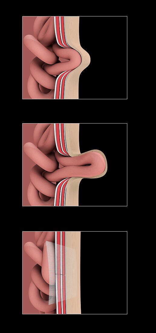 Hernia anatomy and repair, illustration