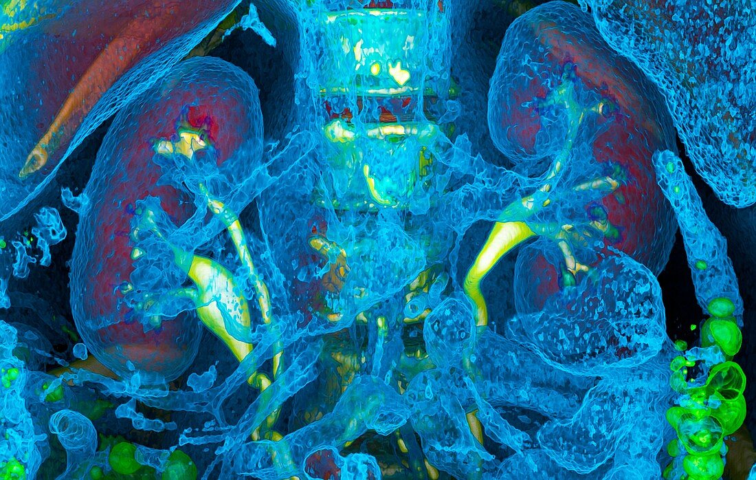 Kidneys and duplicated ureter, CT scan