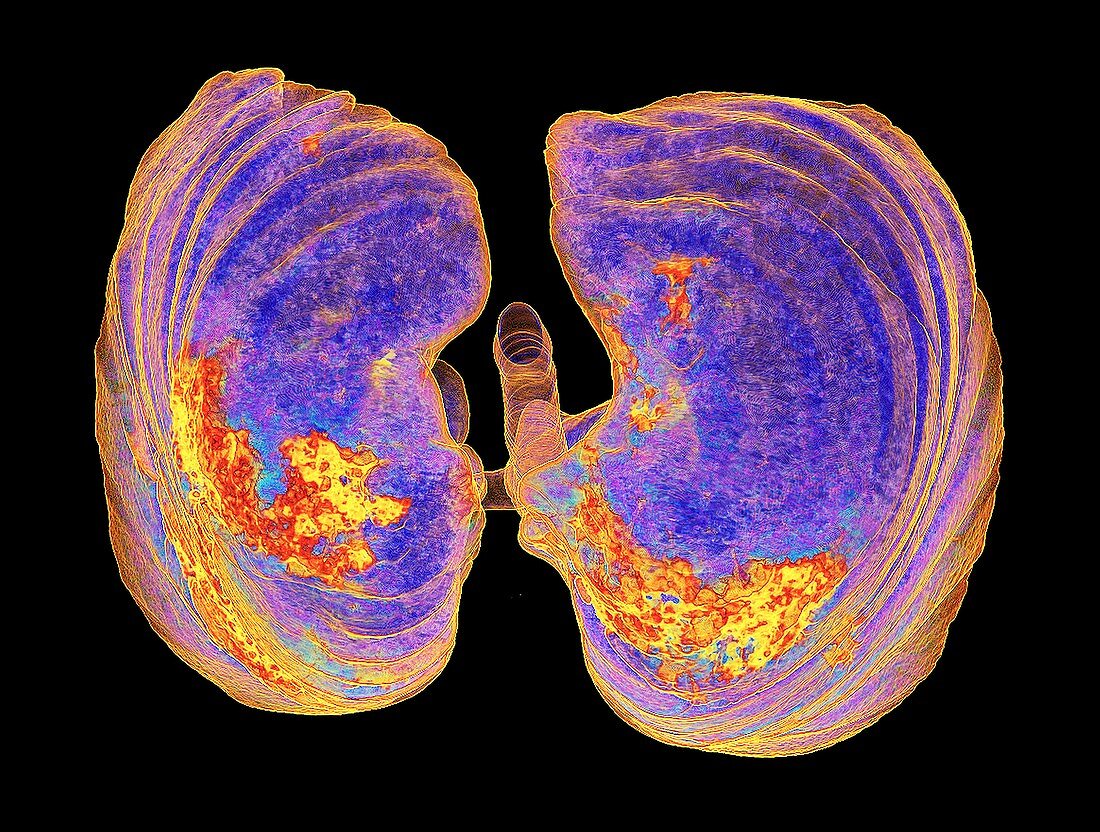 Lungs affected by Covid-19 atypical pneumonia, 3d CT scan