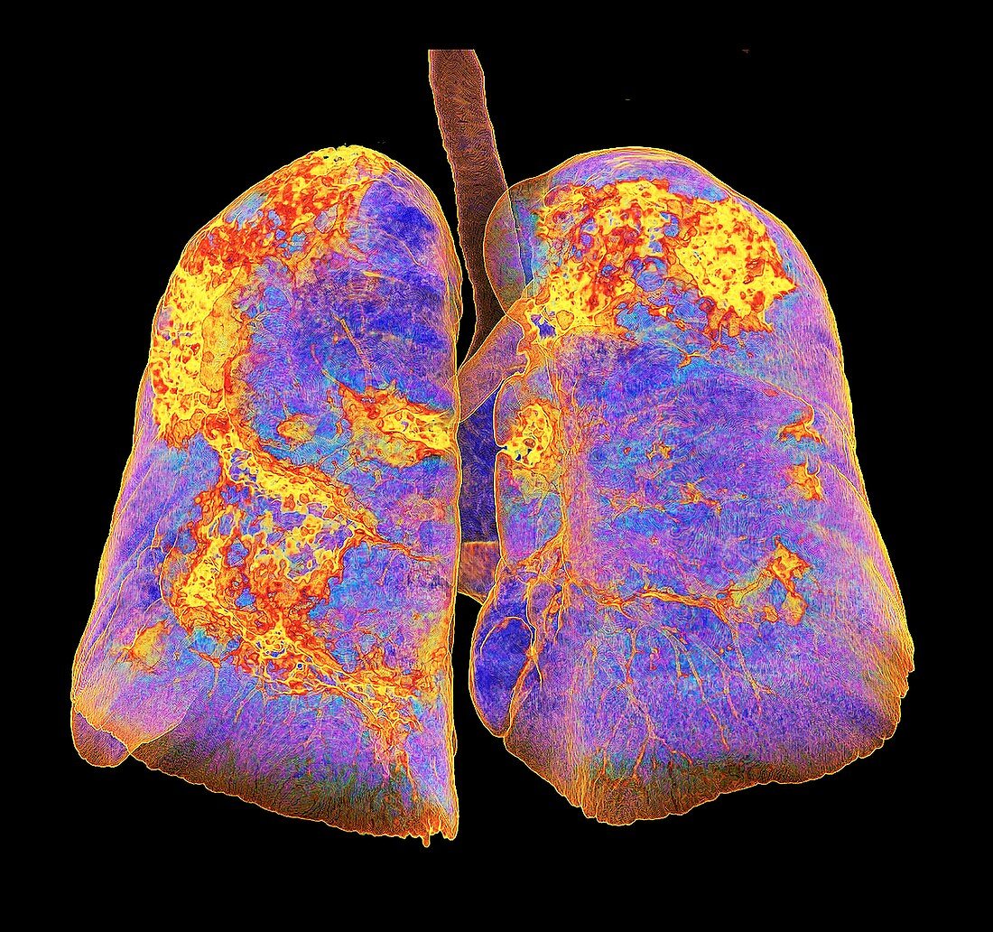 Lungs affected by Covid-19 atypical pneumonia, 3d CT scan