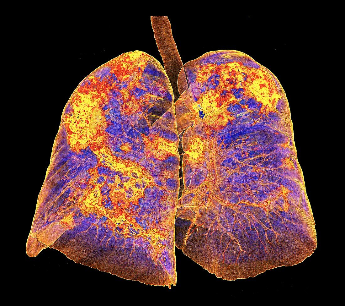 Lungs affected by Covid-19 atypical pneumonia, 3d CT scan