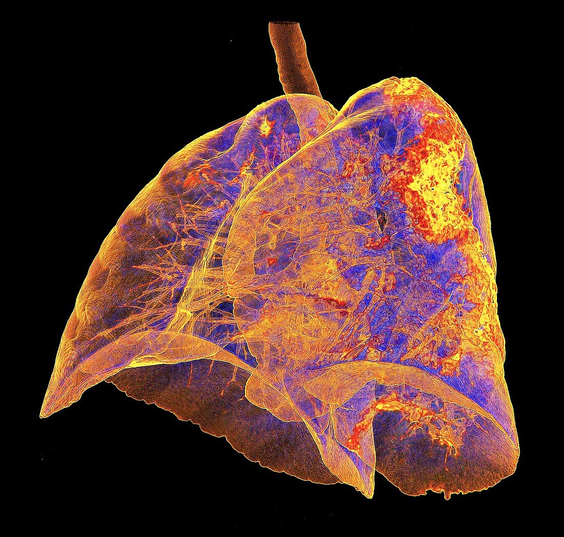 Lungs affected by Covid-19 atypical pneumonia, 3d CT scan