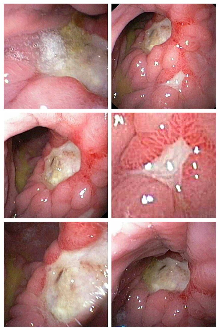 Stomach cancer, endoscopy images