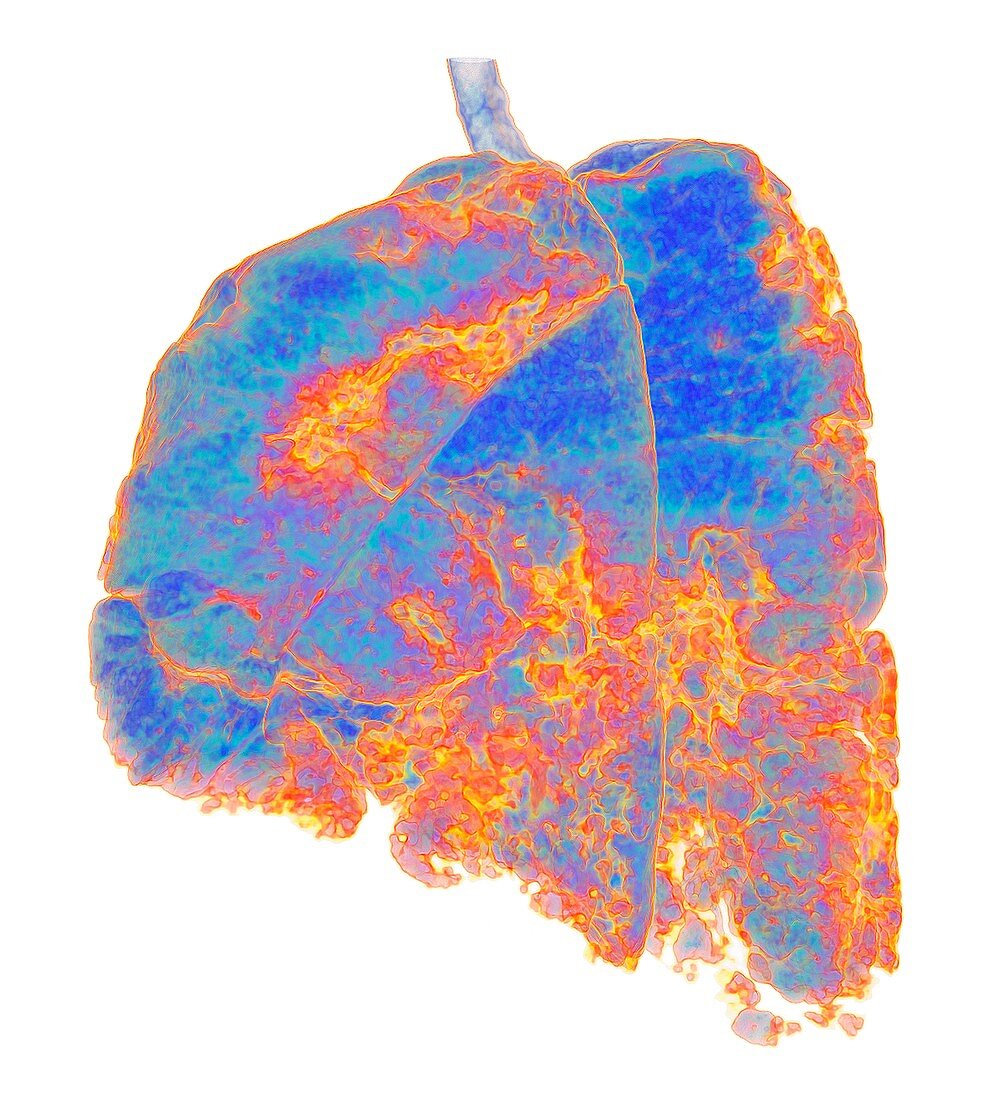 Lungs affected by Covid-19 atypical pneumonia, 3D CT scan