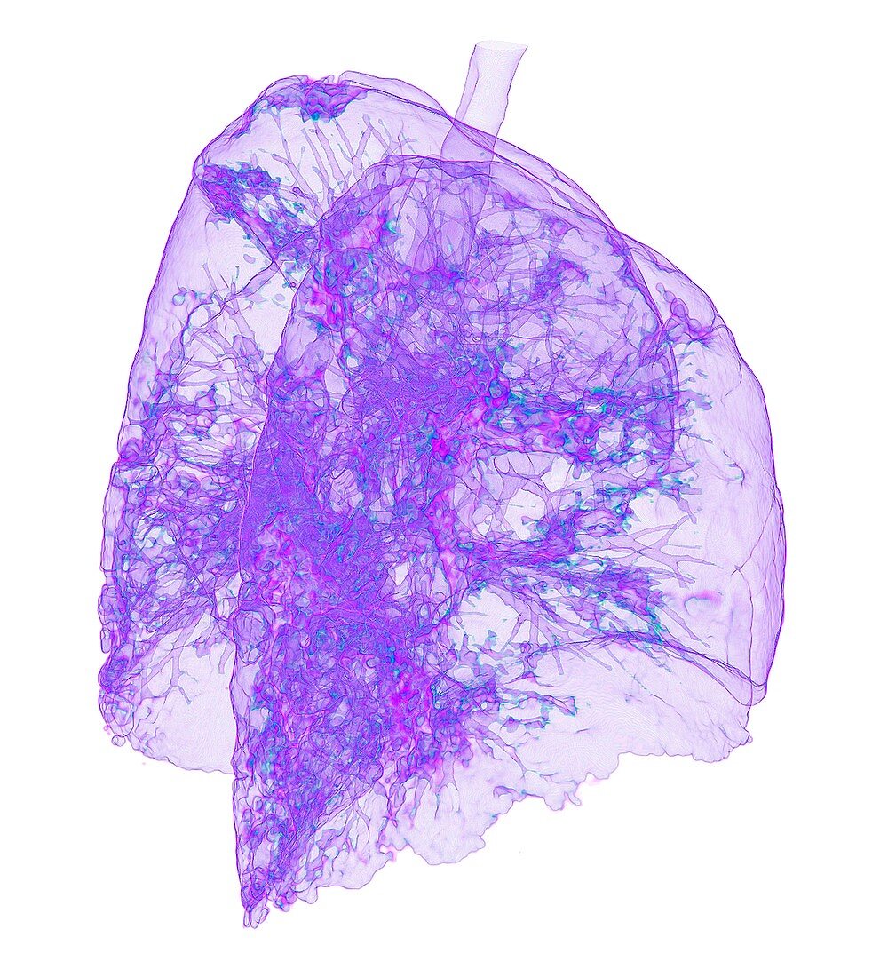 Lungs affected by Covid-19 atypical pneumonia, 3D CT scan