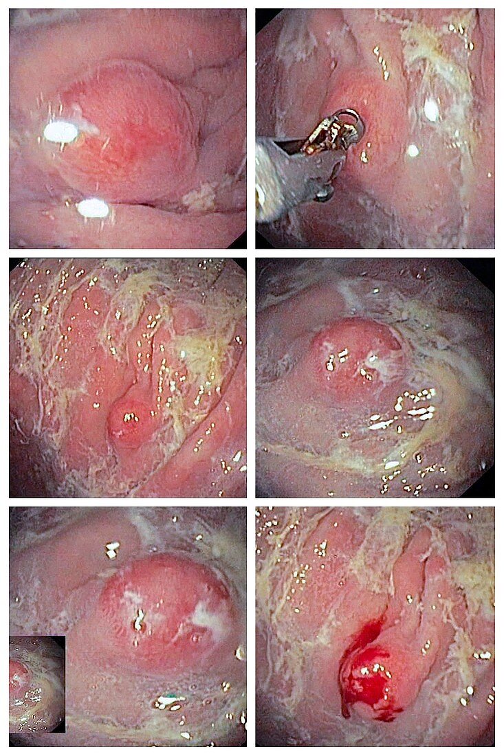 Atrophic gastritis, endoscopy images