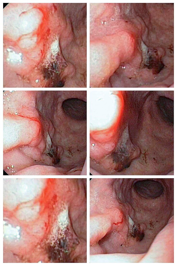 Stomach cancer, endoscopy images