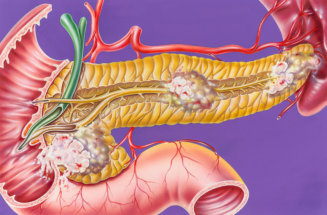 Pancreatic cancers, illustration