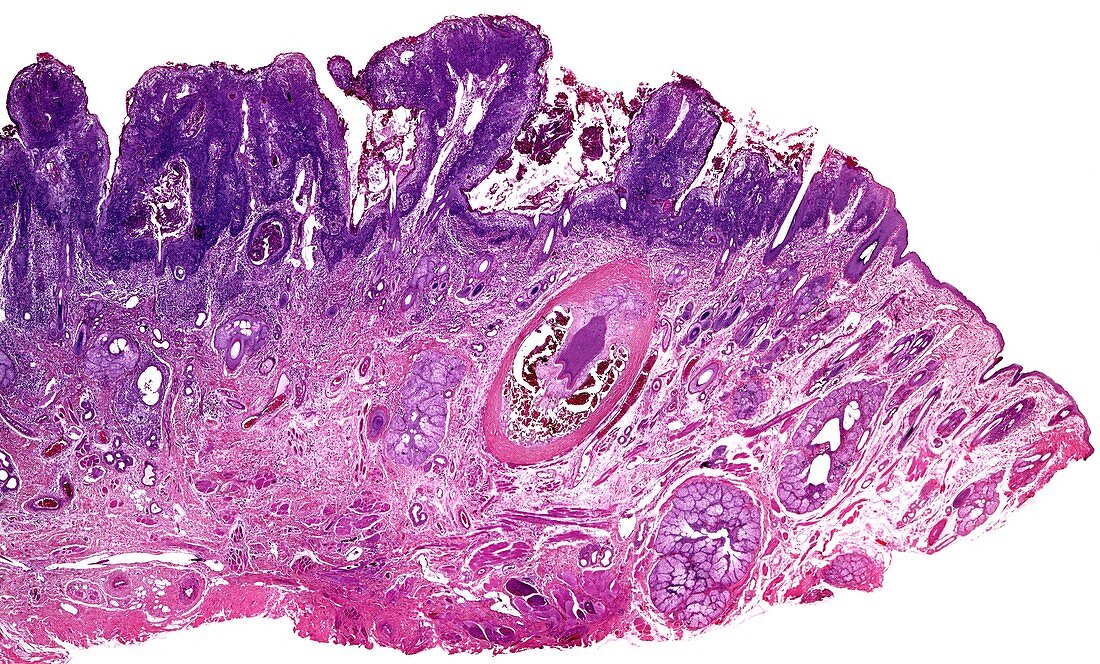 Squamous cell carcinoma, light micrograph