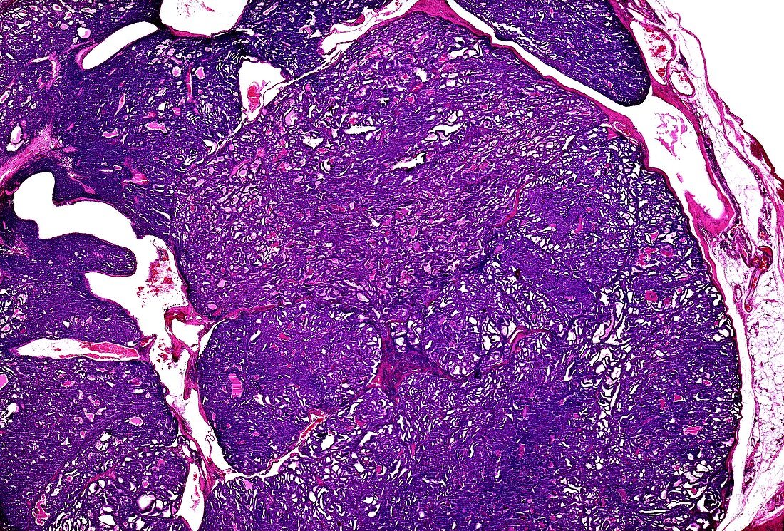 Thyroid adenomatous hyperplasia, light micrograph