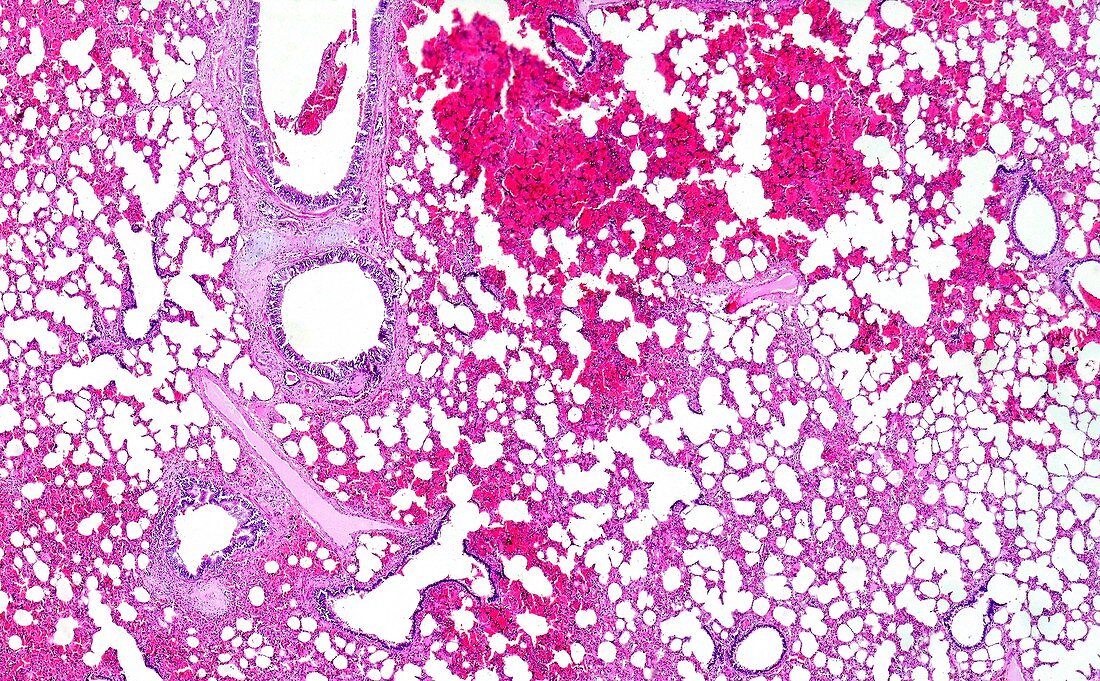 Lobar pneumonia haemorrhagic edema period, light micrograph