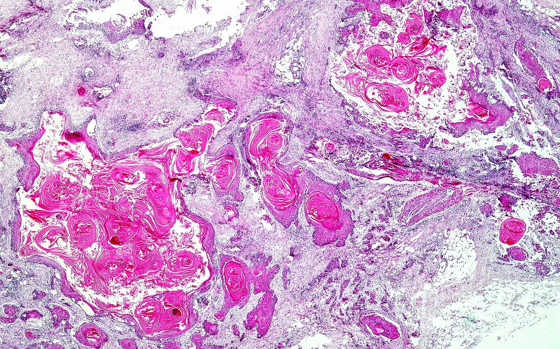 Squamous cell carcinoma of the skin, light micrograph