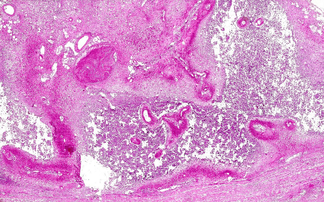 Hereditary diffuse gastric cancer, light micrograph
