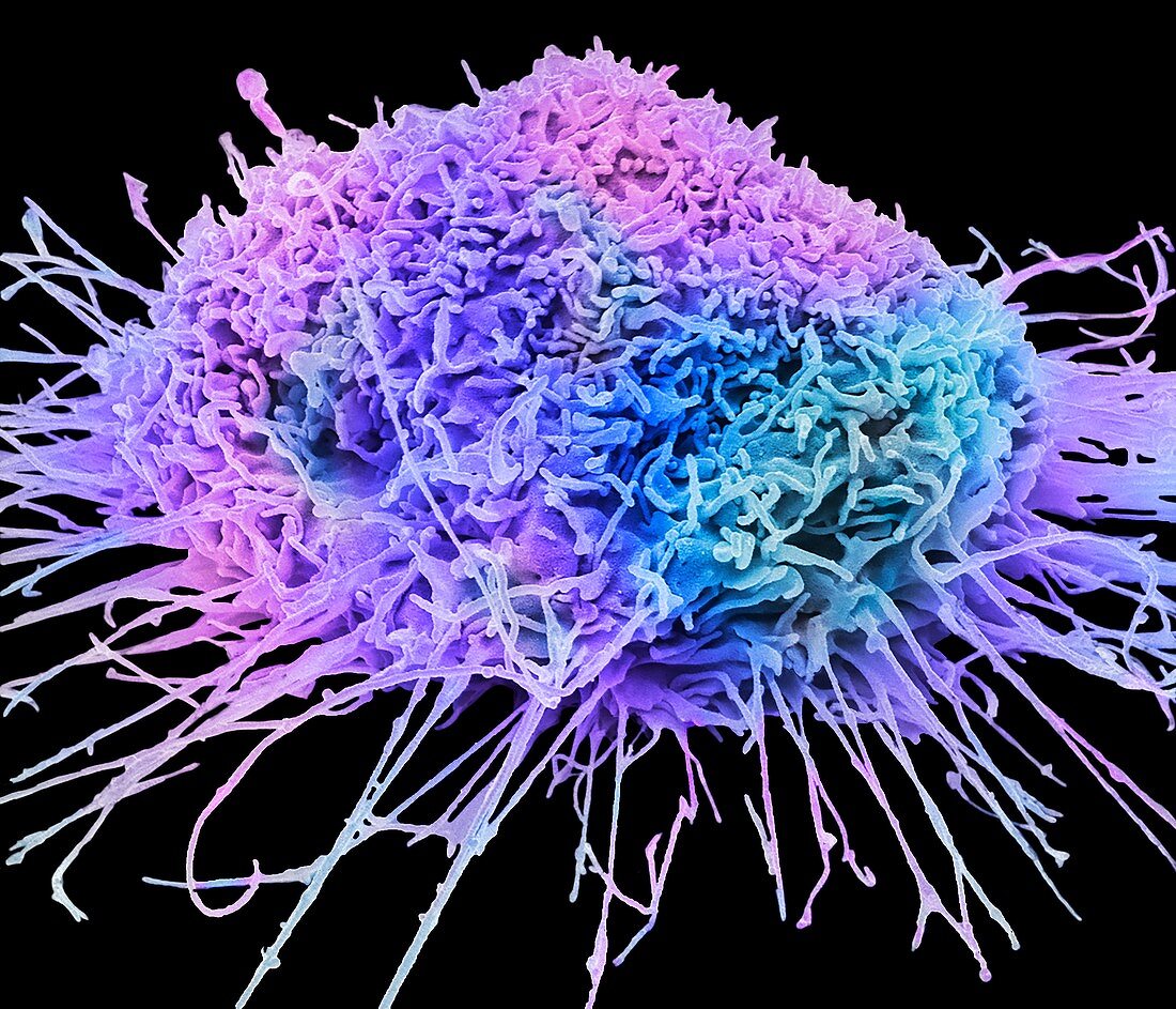 Lung cancer cell, SEM