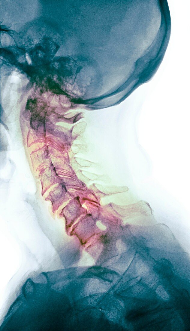 Osteoarthritis of the cervical spine, X-ray