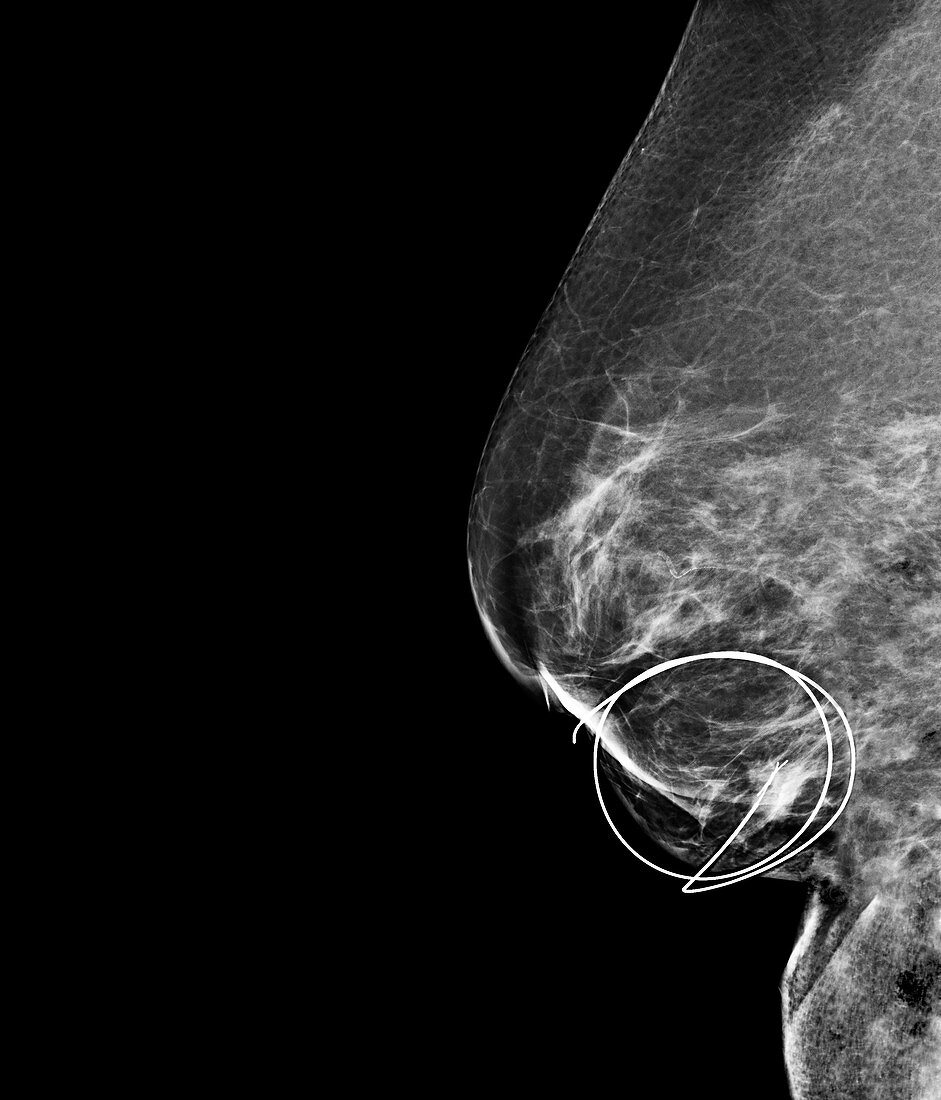 Mammogram of breast cancer surgery