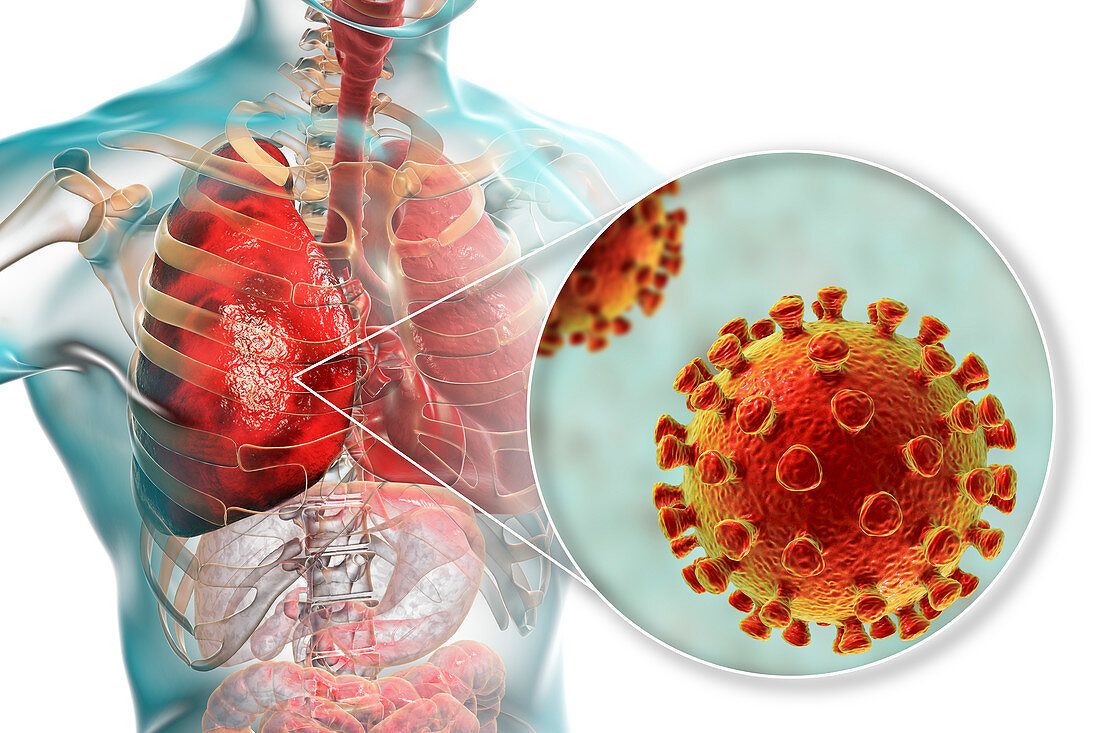 Coronaviruses causing pneumonia, illustration