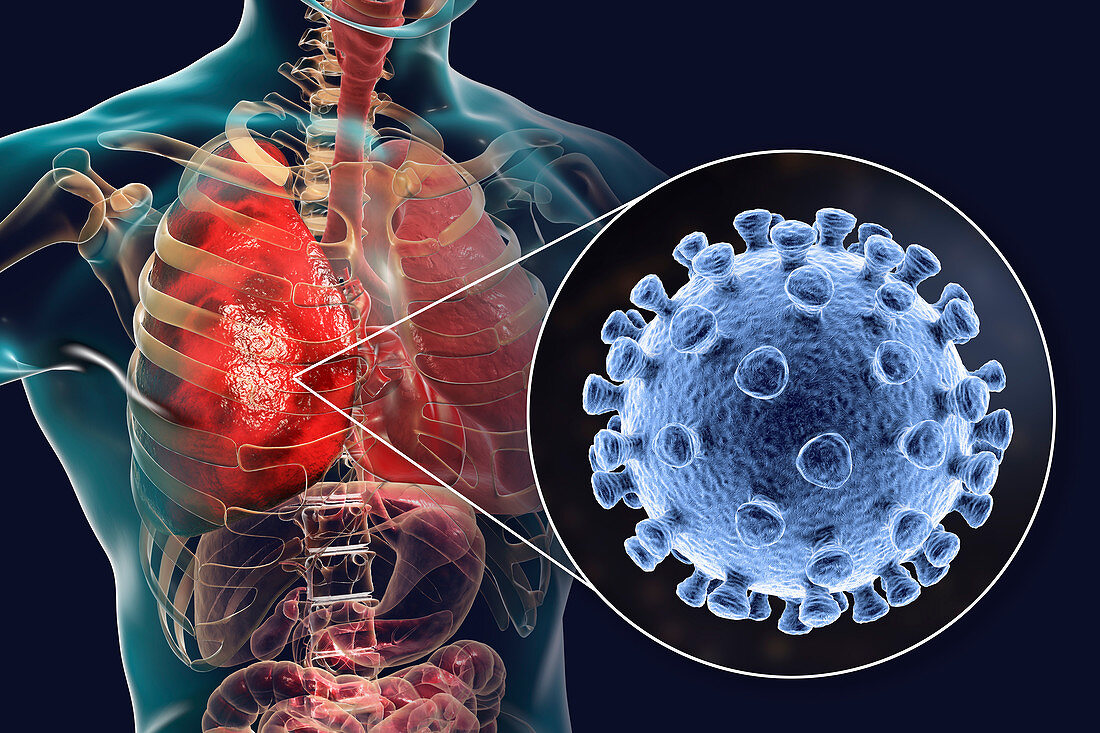 Coronaviruses causing pneumonia, illustration