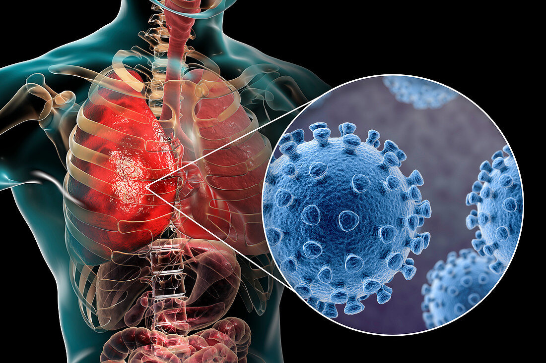 Coronaviruses causing pneumonia, illustration