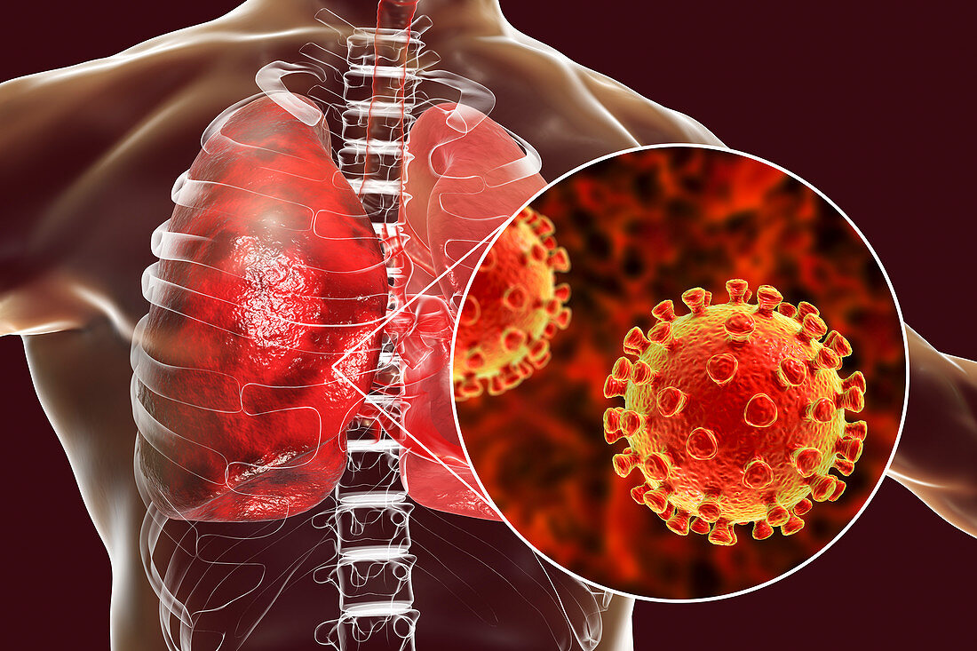 Coronaviruses causing pneumonia, illustration