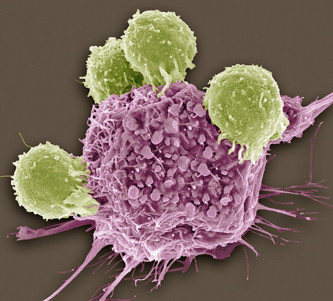 T lymphocytes and cancer cell, SEM